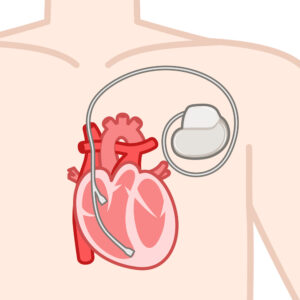 心臓ペースメーカー