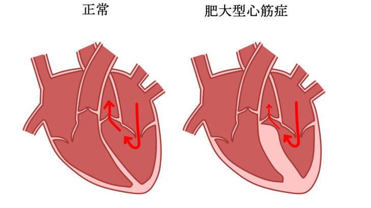 肥大型心筋症